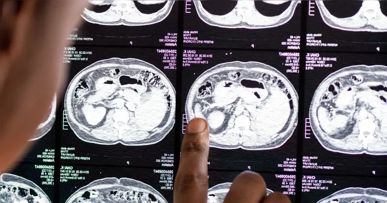 Pesquisa avaliou 2.410 idosos com mais de 65 anos e comparou os hábitos de sono dos participantes com os níveis da proteína tau, associada ao Alzheimer. | Freepik