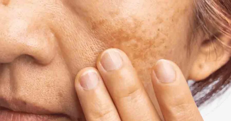 De acordo com a Sociedade Brasileira de Dermatologia, estima-se que cerca de 35% das mulheres brasileiras em idade fértil apresentem algum grau de melasma. | Foto: Freepik